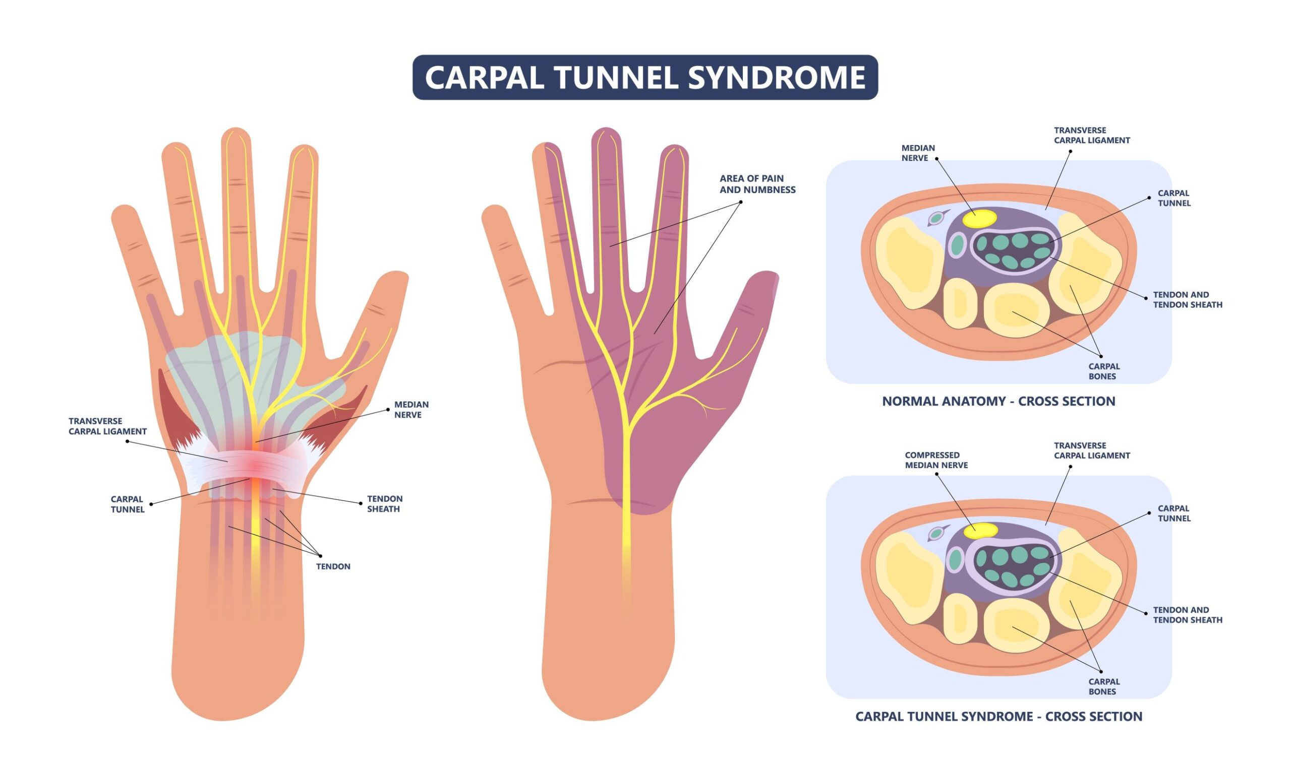 Industry Outlook: Research and Analysis Shaping Carpal Tunnel Syndrome Strategies | DLI