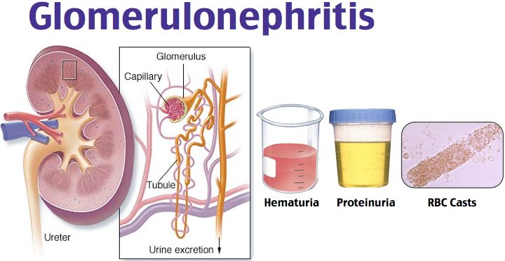 Insights into Glomerulonephritis Disease: Market Trends and Treatment Approaches | DLI