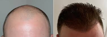 Hair Transplant Without Finasteride ?
