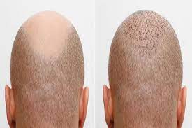 Title: Forever Permanent Nature of FUE Hair Transplants Decoded