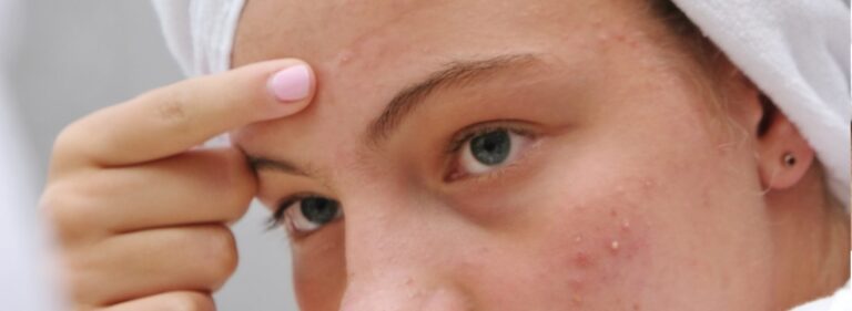 Why Do I Get Frequent Pimples On My Eyebrows?